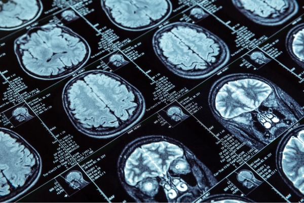 A Guide to Holistic Traumatic Brain Injury Rehab in Denver